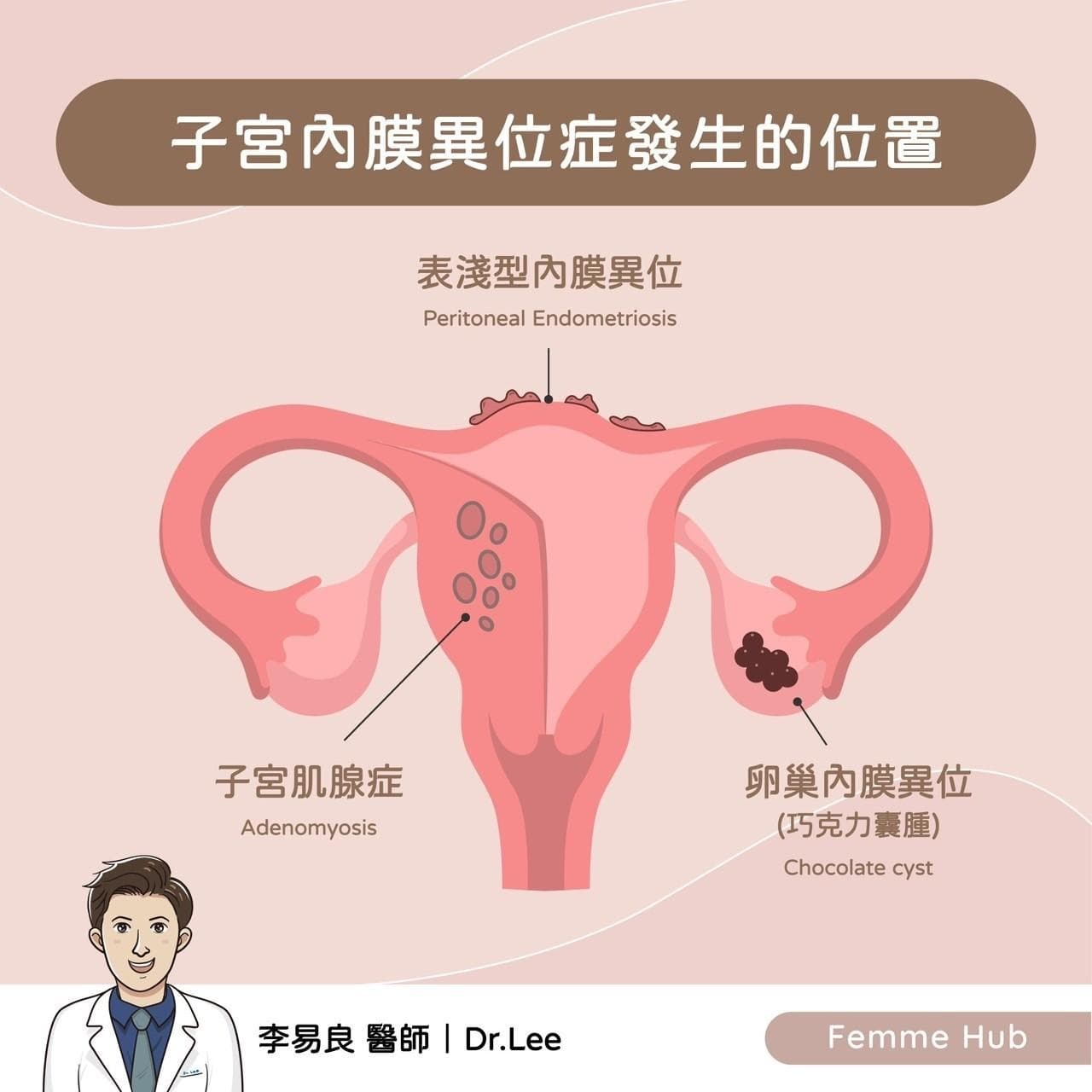 何謂子宮內膜異位症1.jpg