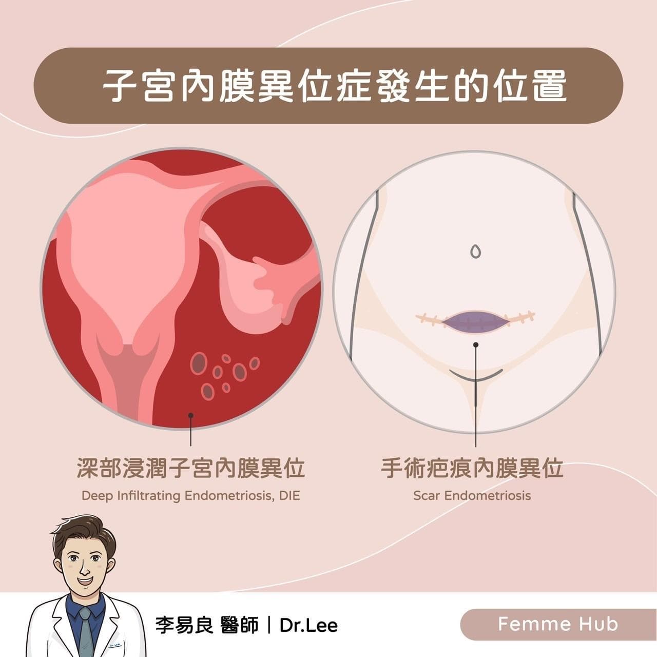 何謂子宮內膜異位症2.jpg